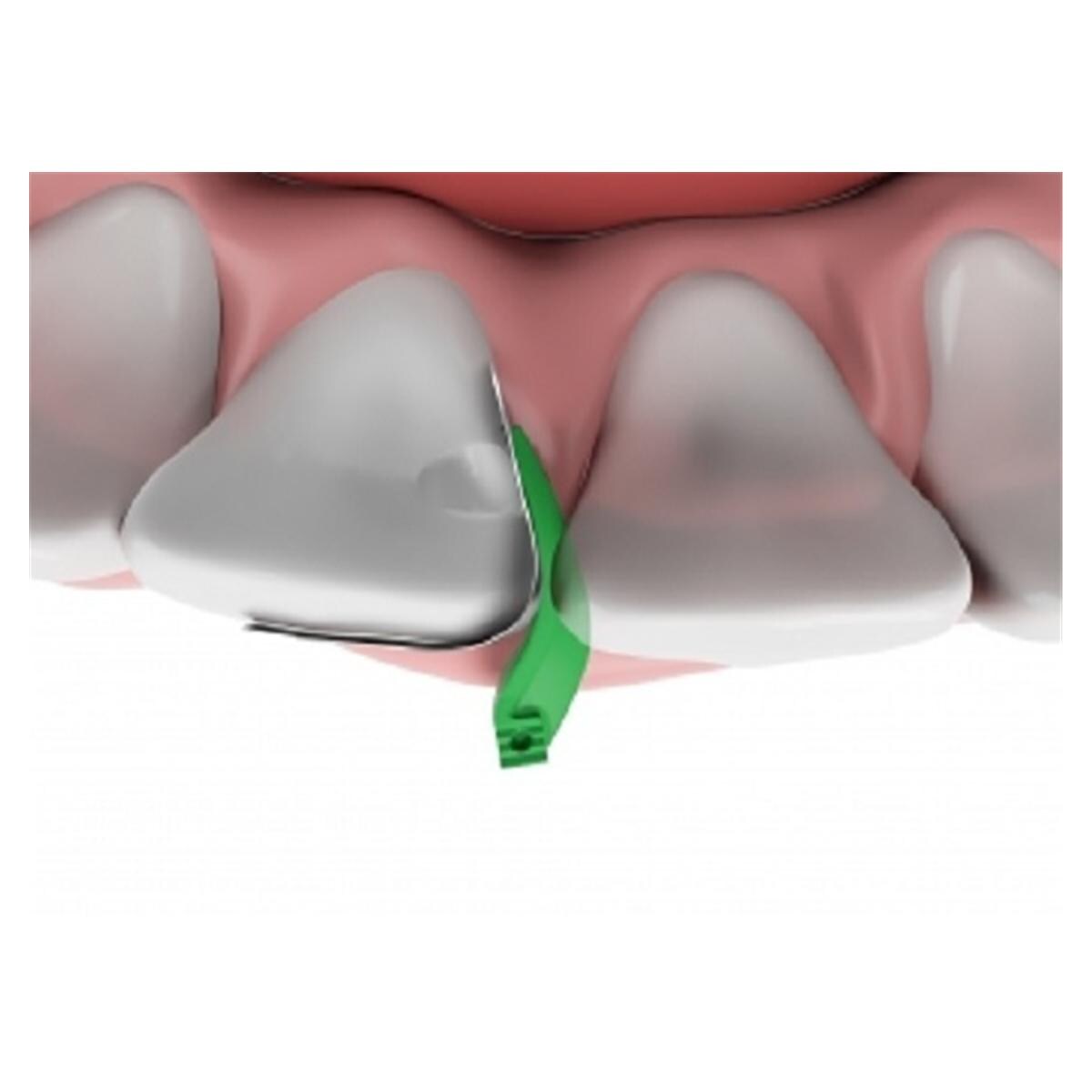 Fusion Anterior Matrix - System Kit - ANK01