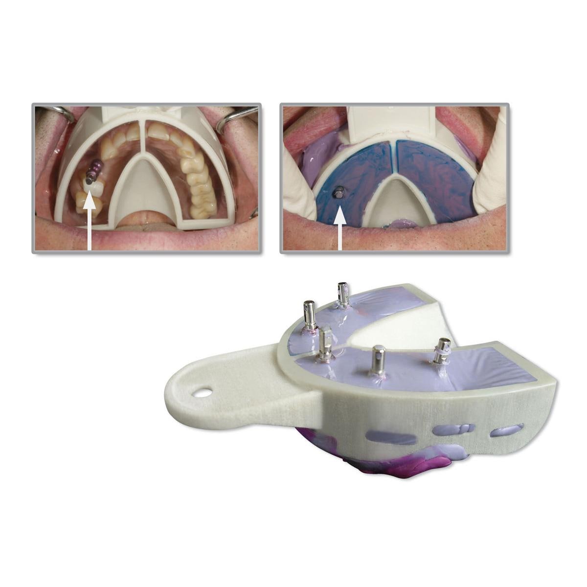 Miratray voor implantaten boven - S1 small