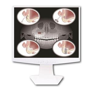 Piezotome 2 - Sinus Lift Set - F87519