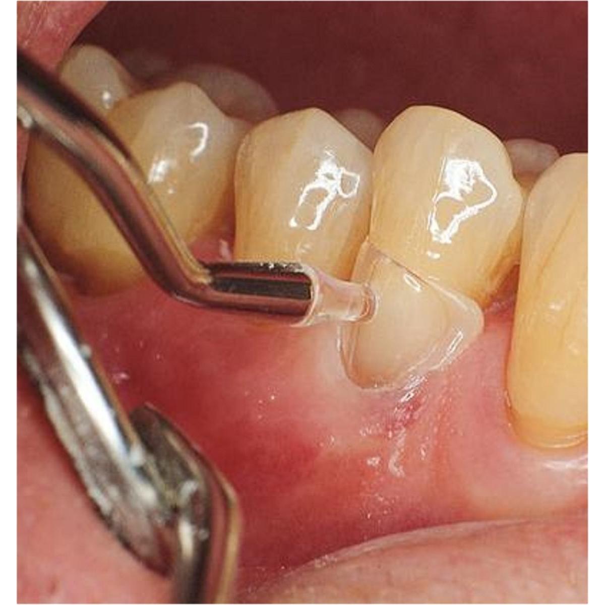 LM-Cervical Matrix - navulling - 7608, molaar groot