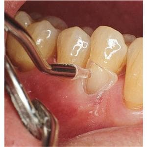 LM-Cervical Matrix - navulling - 7602, incisief