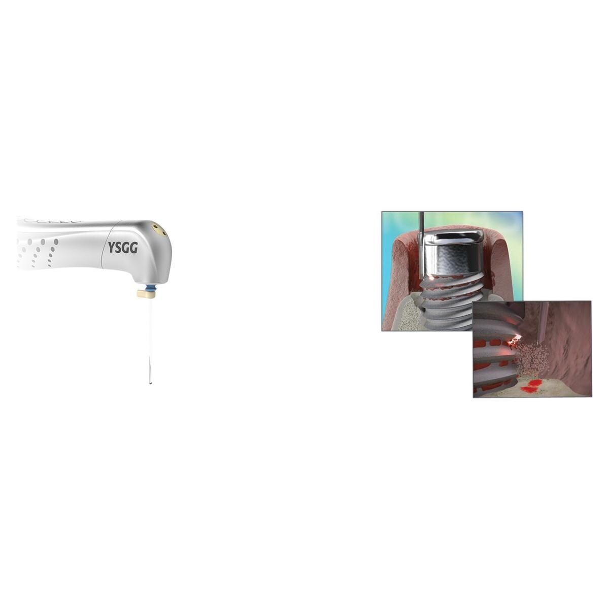 Biolase laser tip Side Fire tip 18 mm - 7230003, 2 stuks