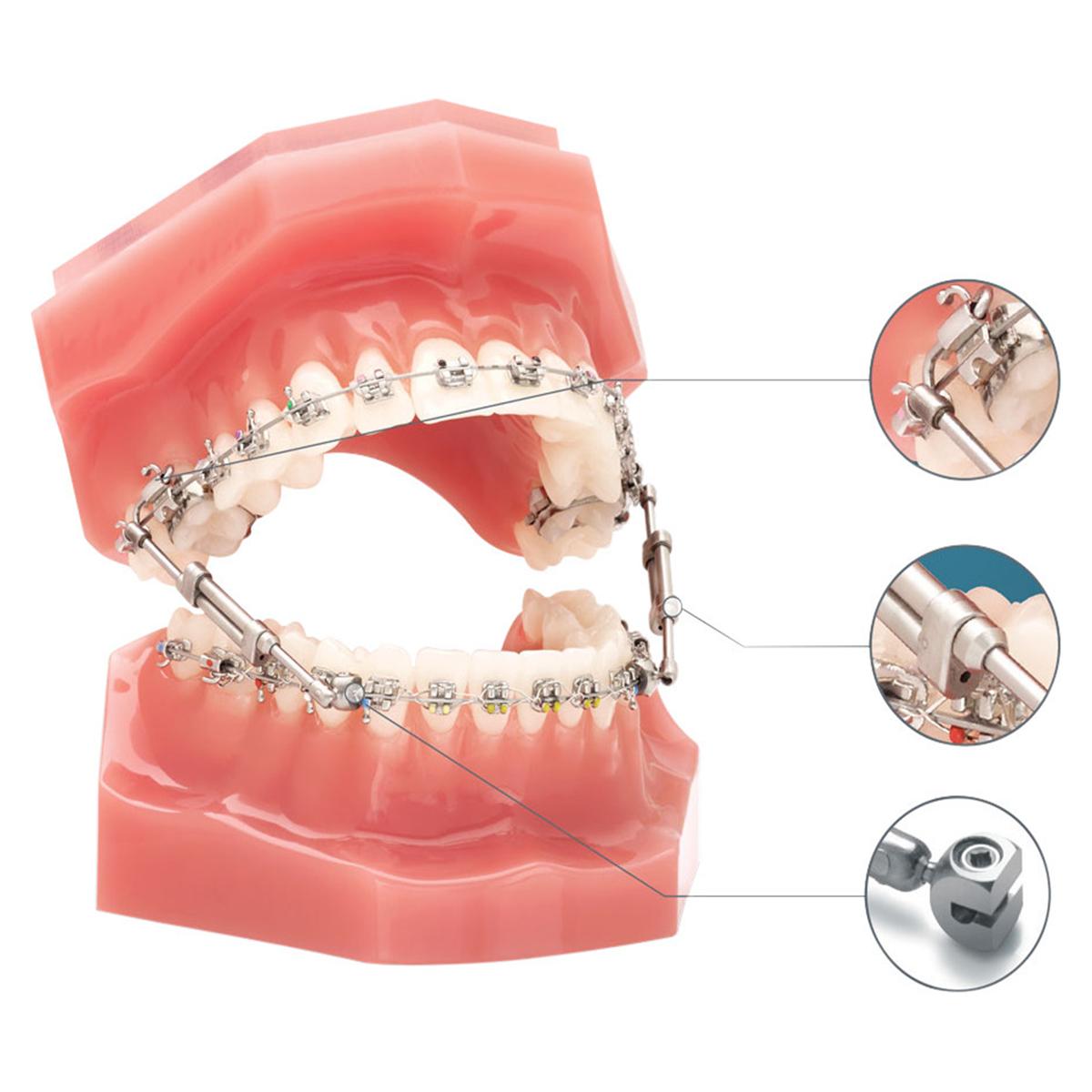 TruEase Bite Corrector Double Lock - TEBC215, 27 mm - 36 mm