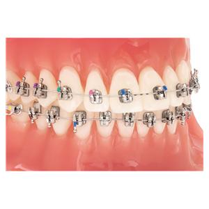 Lotus Plus DS, Passive Roth .022" Slot, Patienten Kit - LPPR22-1300, Upper/Lower - 5x5 + haken op cuspidaten