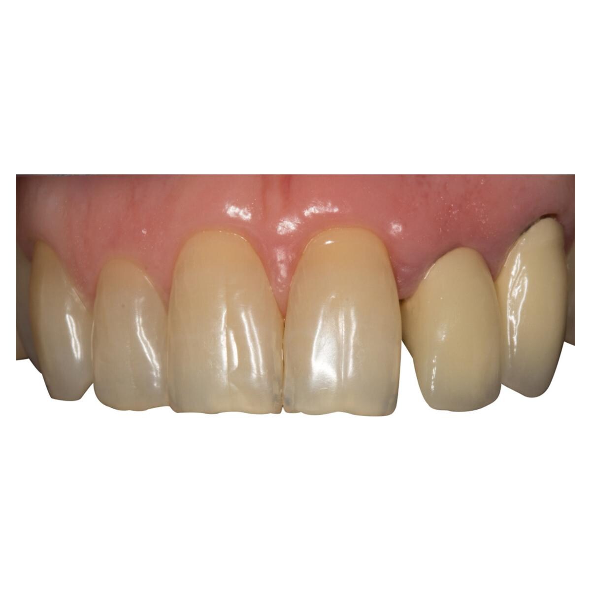 Silicone palatal contrastor - Large - ref. 190781