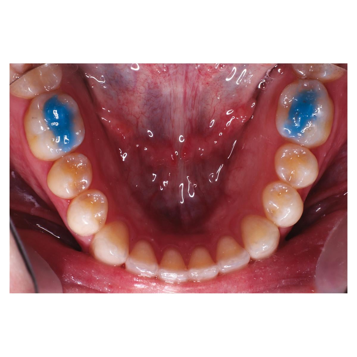 Ultra Band-Lok Blue Shade in Push Syringe - REF. NFUBLBPP, spuitje 5 g