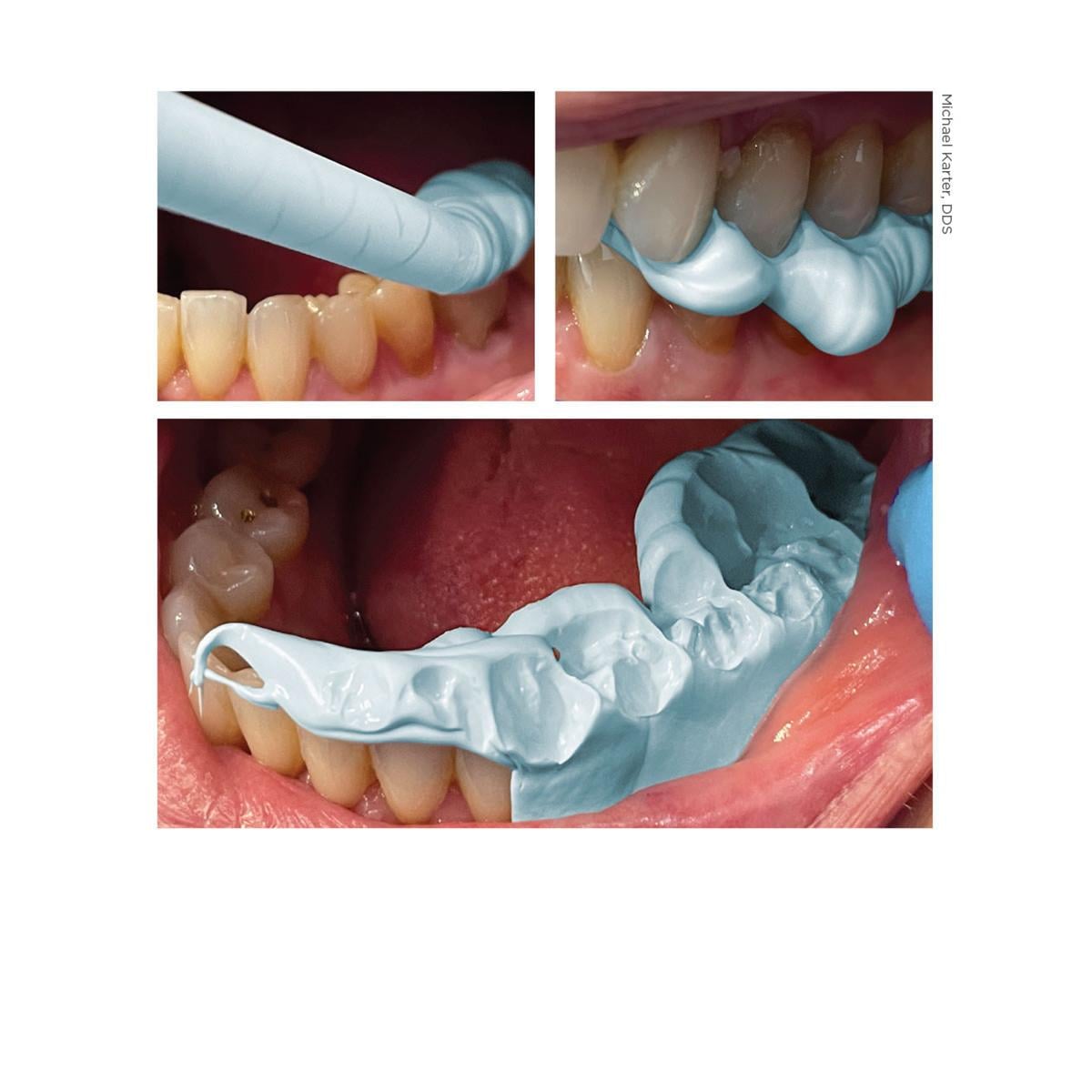 Blu-Mousse Bite Registration 60 (60 sec) - 2x 50 ml en 6 mengtips