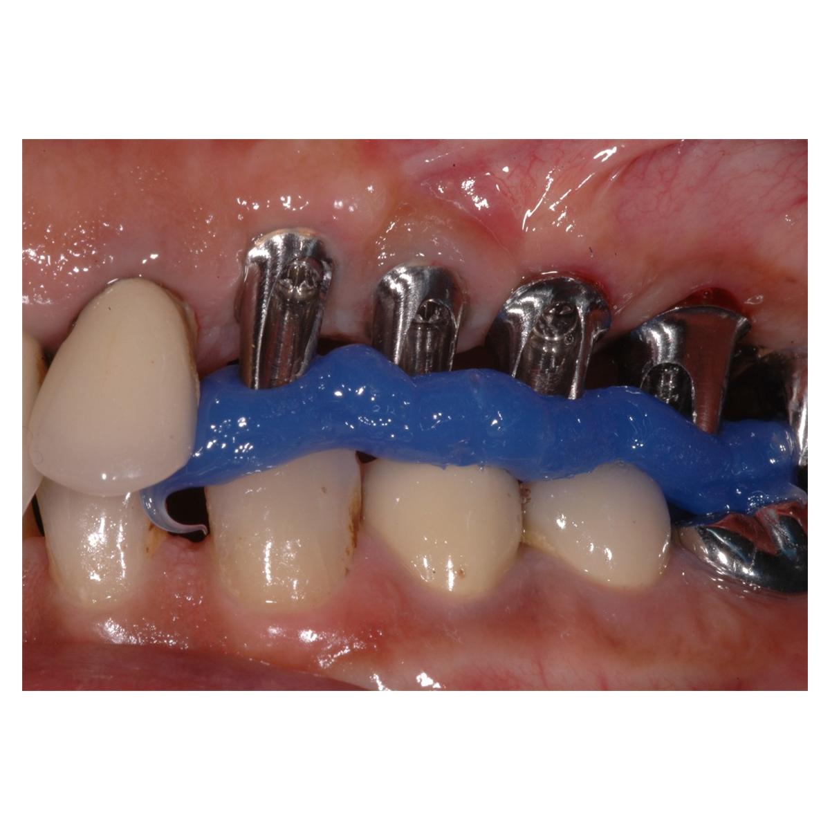 Duroc - Blue, 50ml cartridge + 10 mixing tips