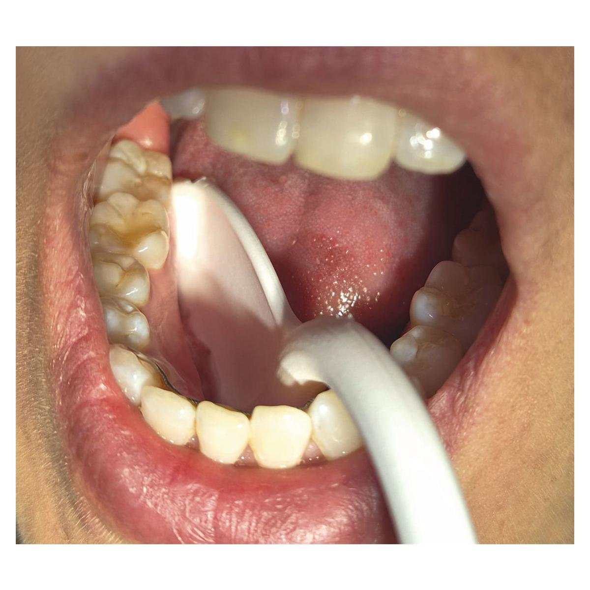 Swe-Flex - 100 stuks